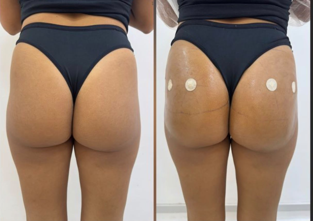 Antes e depois — Harmonização glútea: projeção e contorno
