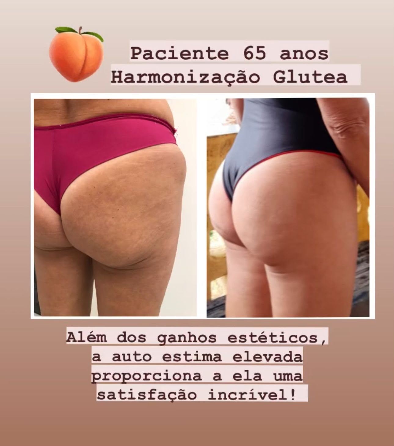 Antes e depois — Harmonização glútea em paciente de 65 anos