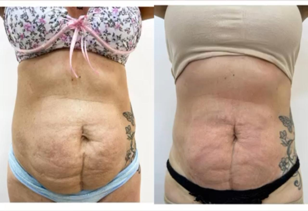 Antes e depois — Endolaser na região abdominal
