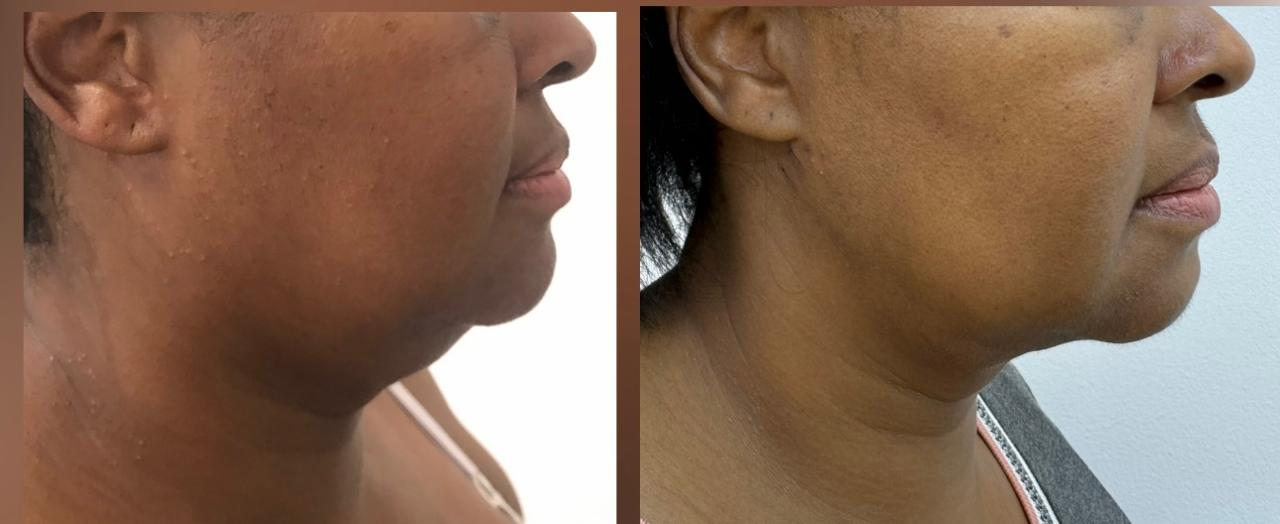 Antes e depois — Endolaser na papada e contorno da mandíbula