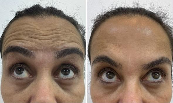 Antes e depois — Botox nas rugas da testa