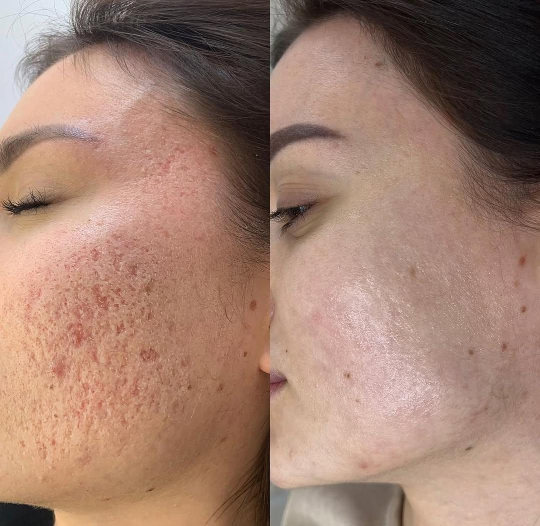 Antes e depois — Laser CO2 Fracionado: cicatrizes de acne